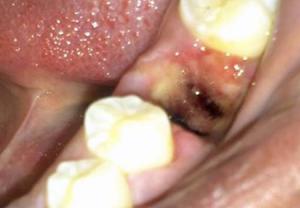 علت تشکیل حفره خشک بعد از کشیدن دندان