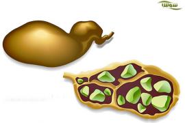 جلوگیری از تشکیل سنگ کیسه صفرا