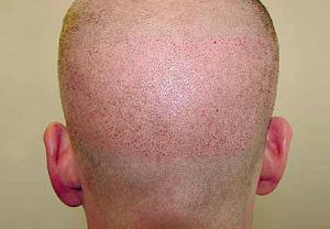 درمان ریزش مو با سلولهای بنیادی