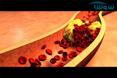 ویدیو آموزشی پاکسازی رگ های قلب با مواد غذایی ویدیو آموزشی پاکسازی رگ های قلب با مواد غذایی
