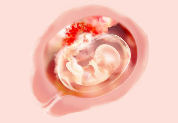 سقط جنین در سه ماهه دوم بارداری