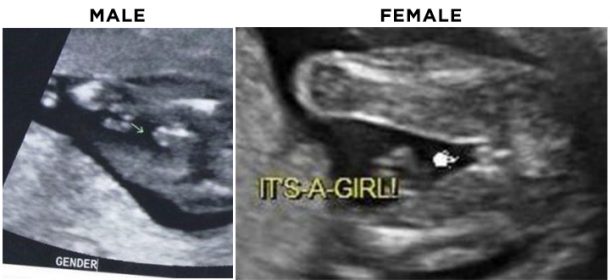 سونوگرافی تعیین جنسیت در هفته شانزدهم بارداری
