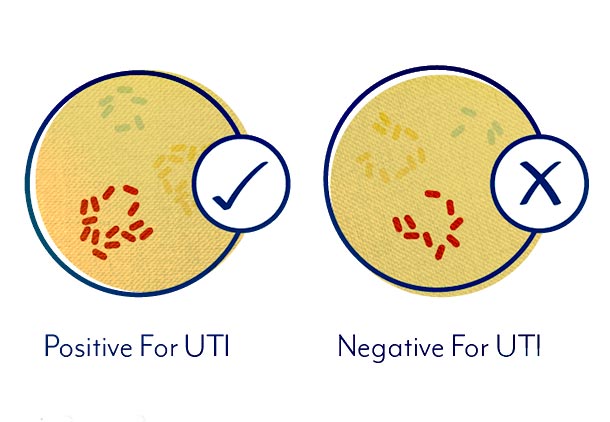 عفونت دستگاه ادراری (UTI)