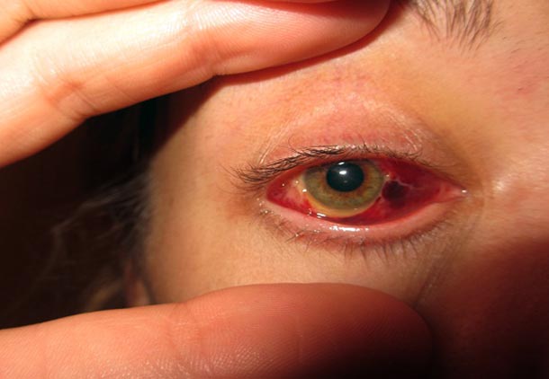 عوارض چشمی بارداری به علت پره اکلامپسی