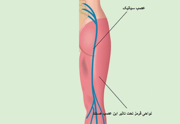 عکس عصب سیاتیک پا