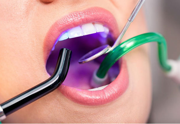 چگونه یک کامپوزیت دندانی در جای خود قرار می‌گیرد؟
