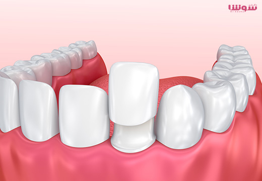 کامپوزیت دندانپزشکی چیست؟ کامپوزیت دندانپزشکی چیست؟