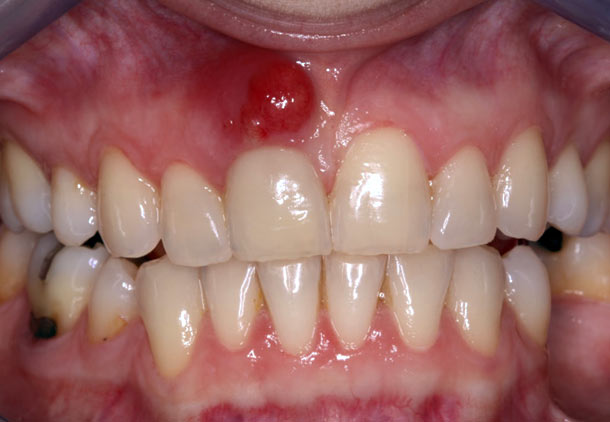 عفونت دندان و گلو درد و مشکلات سینوسی
