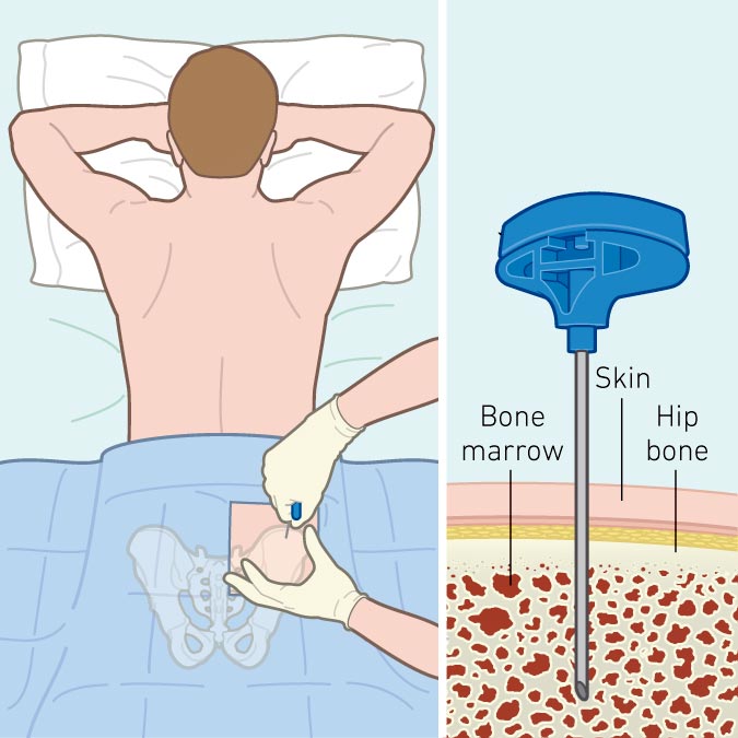 پیوند مغز استخوان در بیماران تالاسمی چگونه انجام می‌شود؟