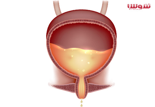 بی اختیاری ادرار | ( Urinary incontinence ) بی اختیاری ادرار | ( Urinary incontinence )