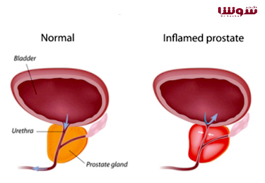 التهاب پروستات – پروستاتیت (Prostatitis) التهاب پروستات - پروستاتیت (Prostatitis)