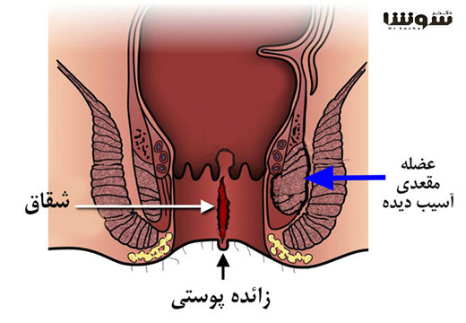 شقاق مقعد – (Anal fissure) شقاق مقعد - (Anal fissure)