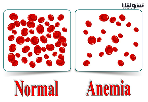 کم خونی – آنمی (Anemia) کم خونی - آنمی (Anemia)