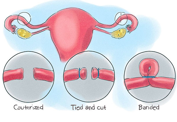 پیشگیری از بارداری : روشهای جراحی پیشگیری از بارداری