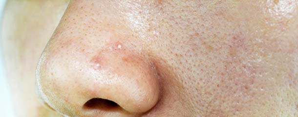 چرب شدن پوست بعد از عمل بینی : چرا بعد از عمل بینی جوش میزنیم