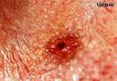 زخم اثنی عشر (Duodenal ulcer)