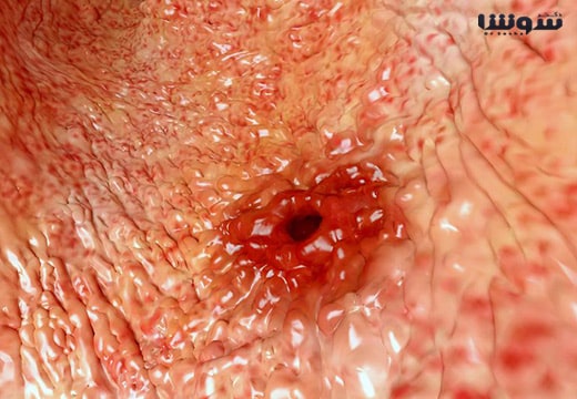 زخم اثنی عشر (Duodenal ulcer) زخم اثنی عشر (Duodenal ulcer)