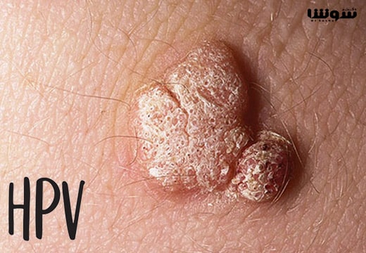 راههای انتقال ویروس hpv +(مراکز تهیه واکسن گارداسیل) راههای انتقال ویروس hpv +(مراکز تهیه واکسن گارداسیل)