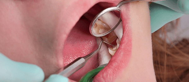 سلامت دهان و دندان در سنین بالا : از دندان‌های پر شده مواظبت کنید