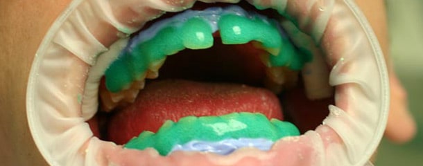 سفيد كردن دندان در مطب : عوارض بلیچینگ دندان