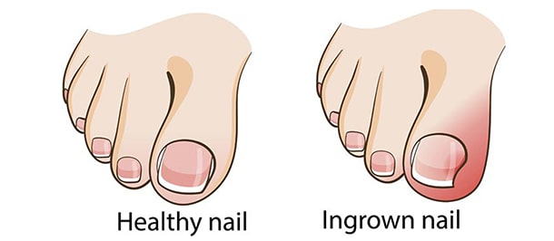 فرو رفتن ناخن در گوشت پا : عوارض بیماری فرو رفتن ناخن در گوشت پا
