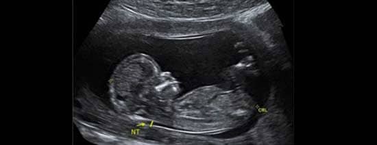 آزمایش غربالگری در سه ماهه اول بارداری : محدودیت آزمایش غربالگری سه ماهه اول بارداری