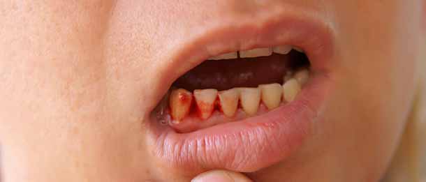 یکی از علل بوی بد دهان بعد از کشیدن دندان خونریزی است
