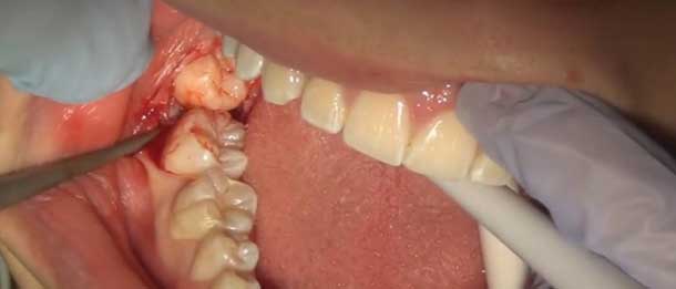 درمان بوی بد دهان بعد از کشیدن دندان