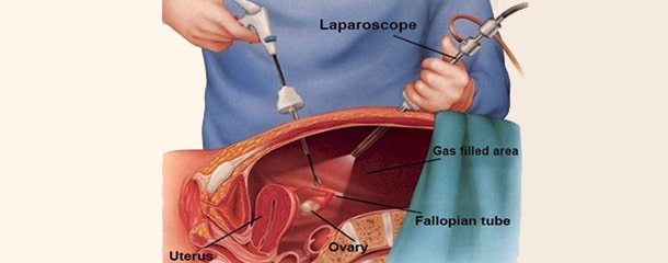 لاپاراسکوپی کیست تخمدان : مراقبت‌های بعد از لاپاراسکوپی کیست تخمدان