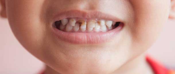 پوسیدگی دندان کودکان : نشانه های پوسیدگی دندان کودکان