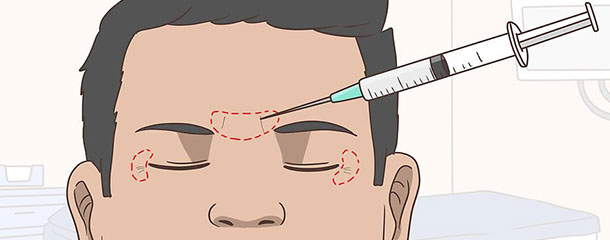  اثر بوتاکس در درمان چروک زیر چشم