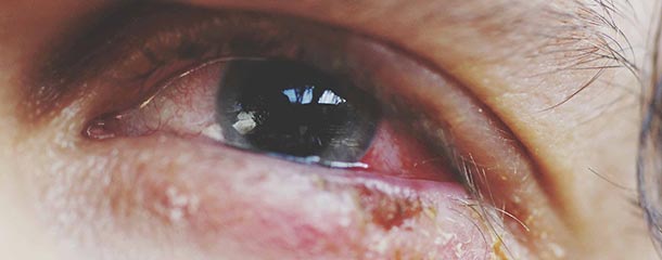 التهاب ملتحمه چشم : علت بیماری کنژنکتیویت