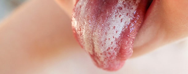 بوی بد دهان در کودکان : خشکی دهان