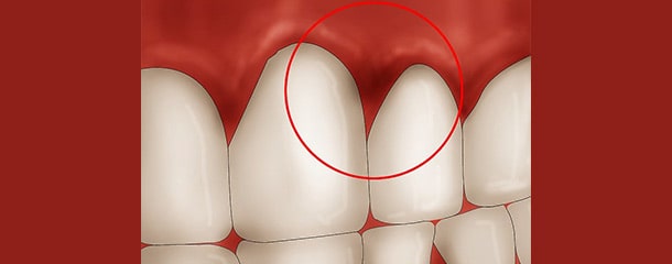 علت قرمزی لثه در اطراف دندان