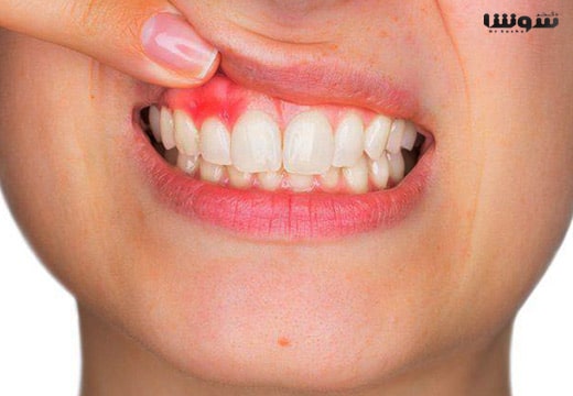 تورم و قرمزی لثه را چگونه درمان کنیم؟ تورم و قرمزی لثه را چگونه درمان کنیم؟