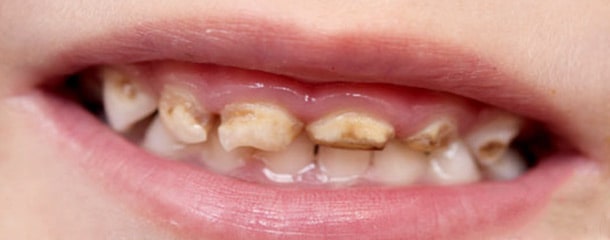 سیاهی دندان کودک با قطره آهن : نکاتی در مورد سیاهی دندان کودک با قطره آهن