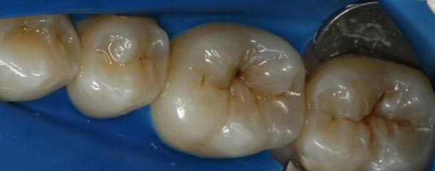 لکه های سیاه روی دندان بر اثر پوسیدگی دندان