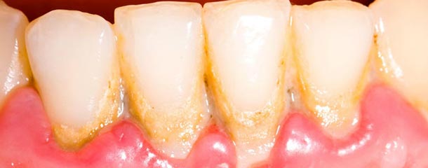 لکه های قهوه ای روی دندان : جرم دندان علت قهوه ای شدن دندان