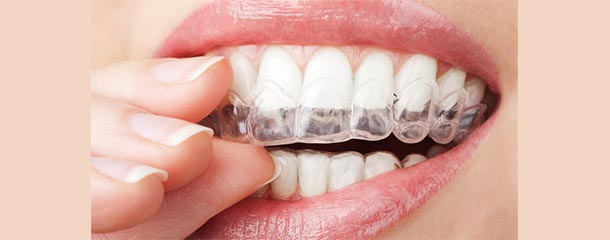 لکه های قهوه ای روی دندان : قالب دندان