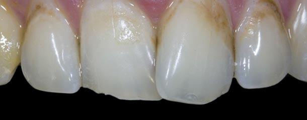 درمان لکه های قهوه ای دندان (سفید کردن لكه قهوه ای روی دندان)