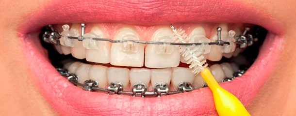 مراقبت از ارتودنسی دندان : مراقبت های بعد از ارتودنسی دندان