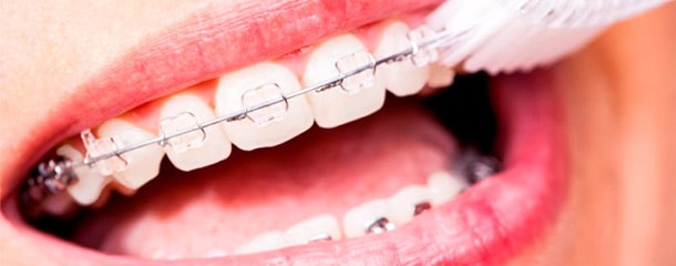 مراقبت از ارتودنسی دندان : نحوه مراقبت از دندان ارتودنسی شده