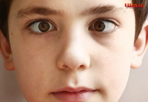 انحراف چشم – استرابیسم – لوچی – Strabismus انحراف چشم - استرابیسم - لوچی - Strabismus