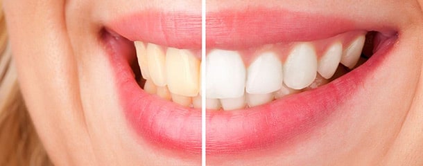 جرم گیری دندان : ایا جرم گیری دندان را سفید میکند؟
