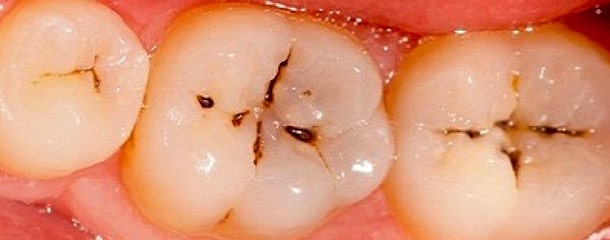 علت درد فک : مشکلات دندانی