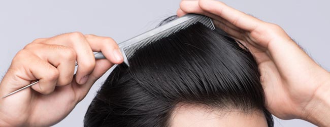 پی آر پی موی سر : آیا درمان ریزش مو با پی آر پی امکان پذیر است؟