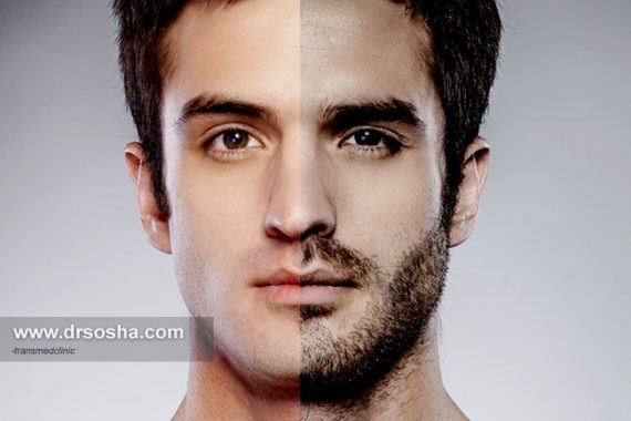 6 روش کاشت ریش و سبیل و نکتههای مهم و کاربردی که باید بدانید 6 روش کاشت ریش و سبیل و نکتههای مهم و کاربردی که باید بدانید