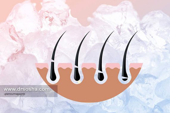 کامل ترین مقاله در خصوص ليزر موهاي زائد کامل ترین مقاله در خصوص ليزر موهاي زائد
