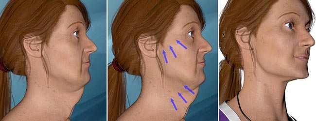 لیفت گردن و غبغب : لیفت و کشیدن پوست گردن (ریتیدکتومی Rhytidectomy)چست؟ و دقیقاً چه کاری انجام می دهد؟