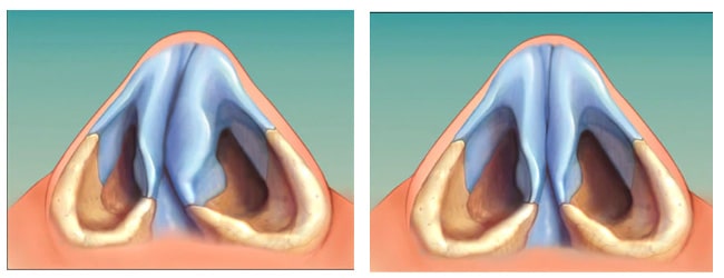 جراحی انحراف بینی : عکس قبل و بعد عمل جراحی انحراف بینی